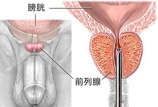 慢性前列腺炎会影响怀孕吗