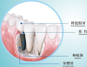 大牙拔掉可以不再镶牙吗？