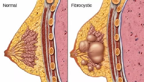 乳腺增生和心情不好有关系吗