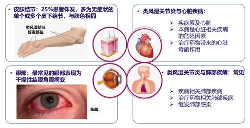 孕晚期出现手指疼痛,一定要警惕宫缩吗