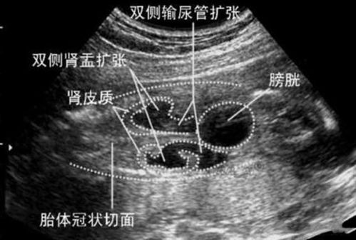 30周+5胎儿胎儿双肾集合系统分离