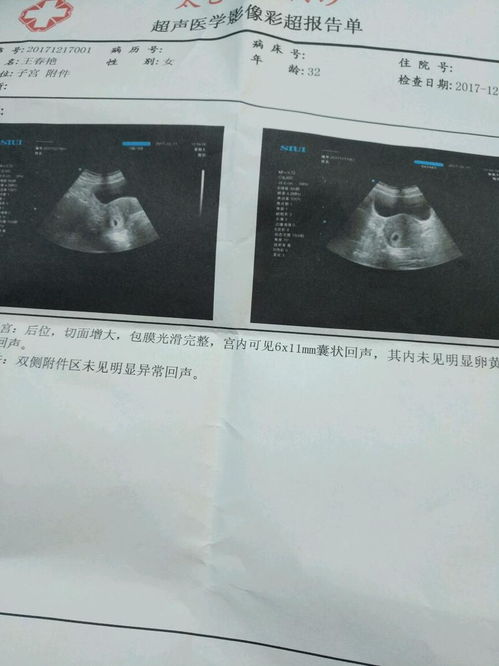 通过孕囊大小判断怀孕天数准吗