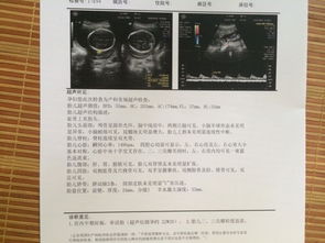 胎儿三尖瓣返流怎么回事儿