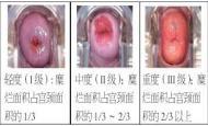 女性宫颈炎影响受孕吗