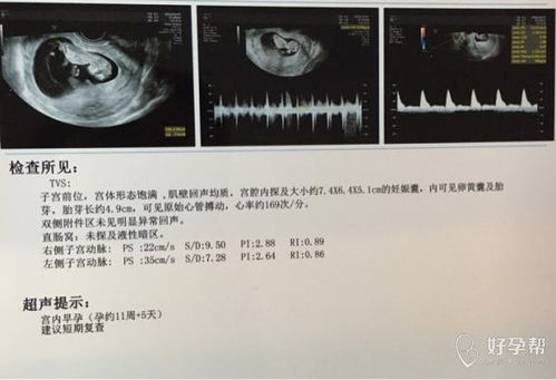 怀孕52天B超检查宫腔内见妊娠囊30*11mm内隐约见卵黄囊未见明显胎芽及心管搏动，请问正常么 ，谢谢