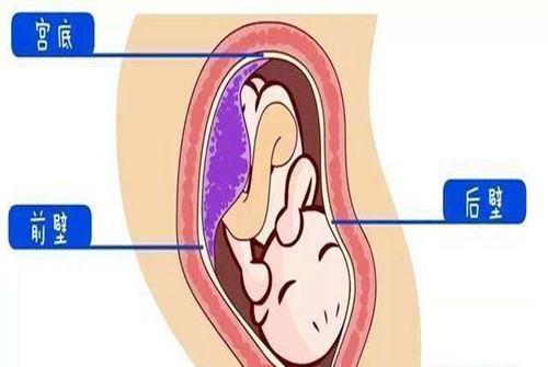 胎盘前壁可以剖腹产吗?