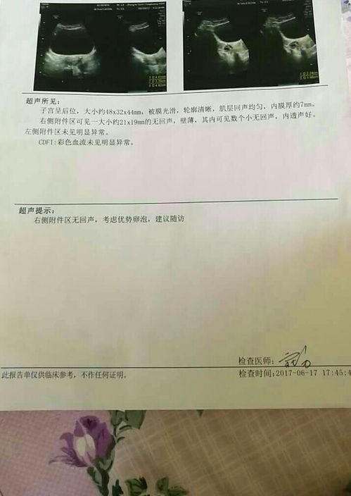 盆腔积液是怎么回事儿?