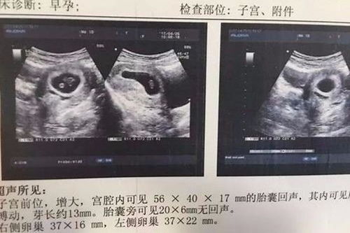 请问妇科超声显示孕囊20*26*15mm是什么形状？