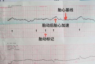 怀孕三个月胎儿心率161一分钟是不是表示缺氧吗？