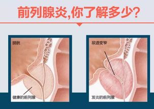 前列腺液检查白细胞一个加是什么意思