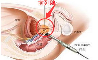 前列腺液检查白细胞一个加是什么意思