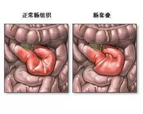 假性尖锐疣很痒正常吗