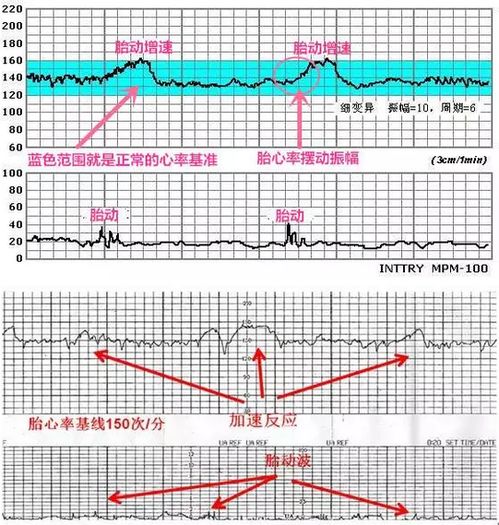 胎心监护怎么看胎心率