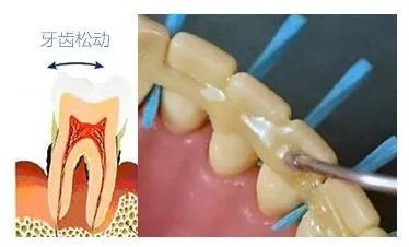 宁波活动假牙松了怎么办？