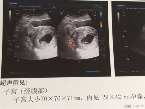 受孕几周可以看到孕黄囊