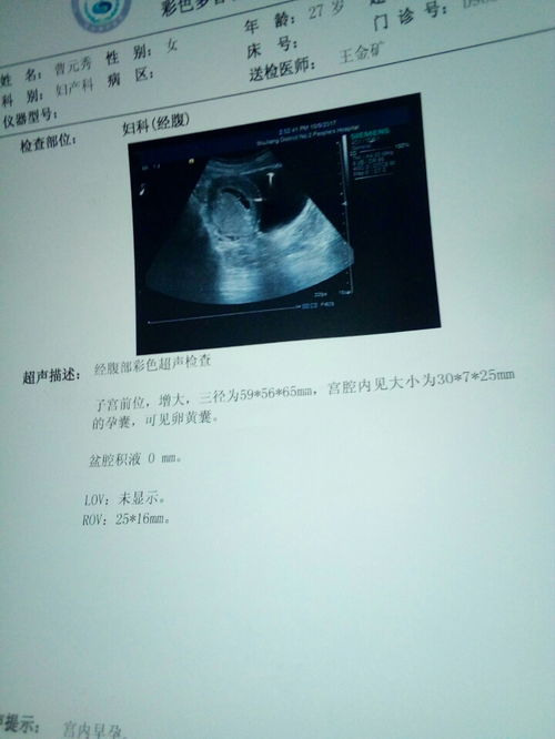 怀孕44天孕囊32*22*43是什么形状