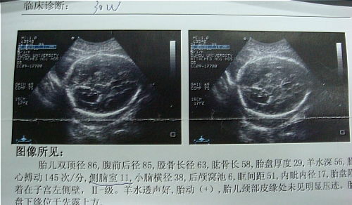 胎儿侧脑室增宽标准值是多少