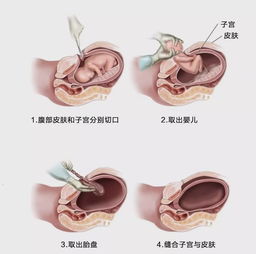 宫外孕需要手术吗？