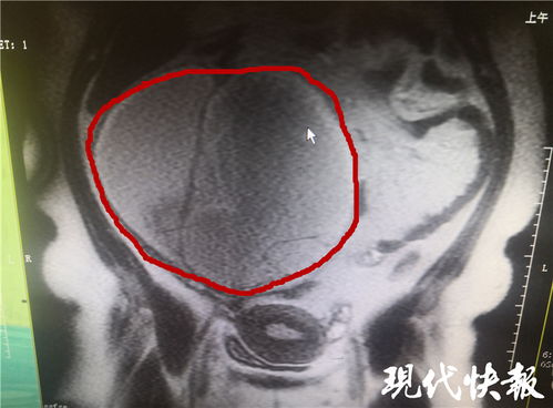 直径八厘米的卵巢囊肿如何治疗？