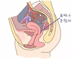 女性盆腔炎多发生在