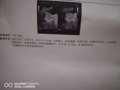 宫内孕囊大小16*12mm不规则孕囊回声囊内见卵黄囊未见胎芽，是怀孕多长时间了？