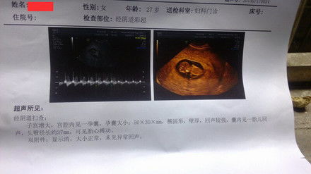 12周查出水囊瘤nt增厚13周水囊瘤吸收了畸形大吗