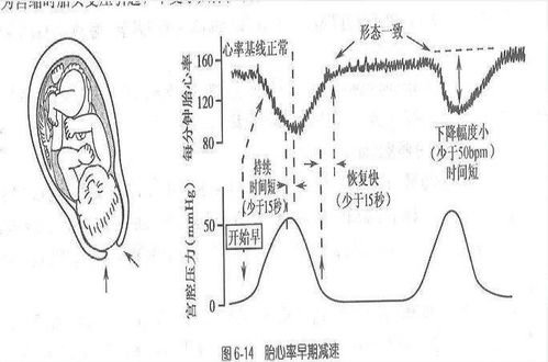 胎心监护如何快速通过检查