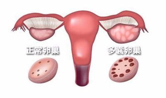 吃鹿胎膏可以治疗多囊吗