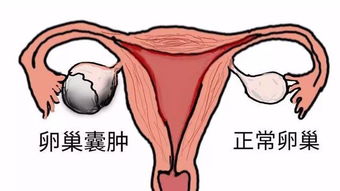 孕早期卵巢囊肿要紧么