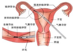 造成输卵管堵塞的原因是什么呢