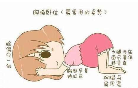 胎位不正如何纠正图