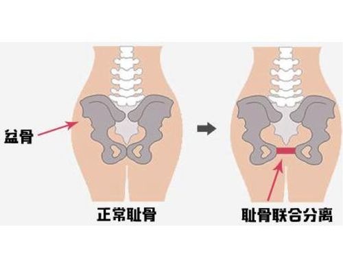 孕期怎样缓解趾骨联合痛的症状