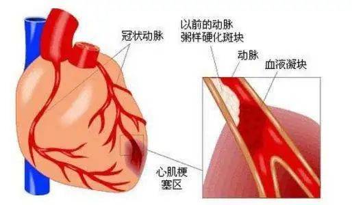 睾丸癌是由什么引起的