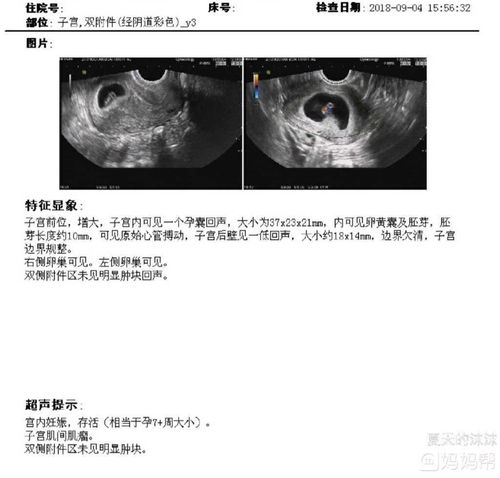 做B超检查算孩子多少天是否准确?