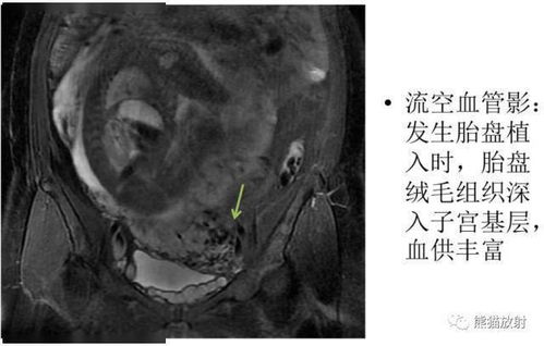 胎盘植入12周做nt能查出来吗