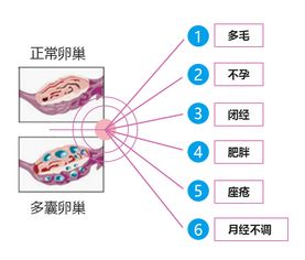 女人有多囊可以怀孕吗