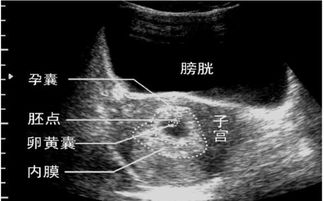 怀空孕囊和胚胎停育的区别