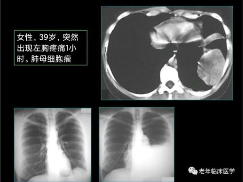 产前感染性肺炎严重吗