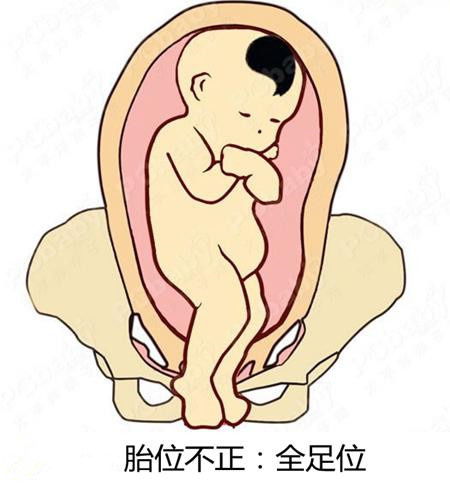 胎位不正时选择哪种生产方式好