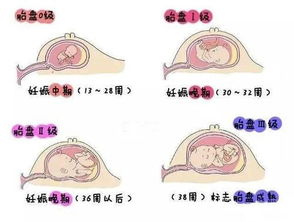 24周胎盘成熟度1级正常吗怎么控制