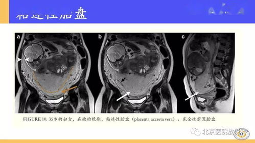 葡萄胎是怎样形成的?