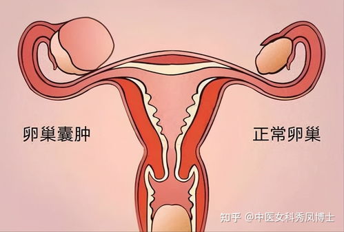 导致女性不孕的4个原因