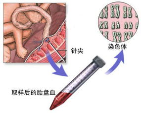 脐带血穿刺可以报销吗