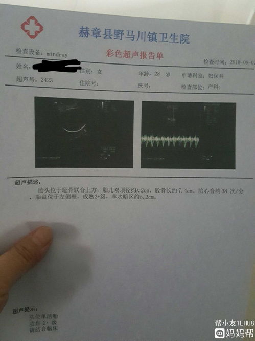 孕囊大小24*10*33mm是什么意思？