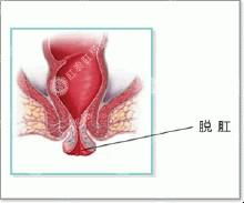 直肠粘膜脱垂