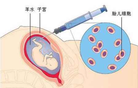 羊水穿刺的初步结果准确吗