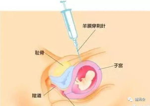 羊水穿刺的初步结果准确吗