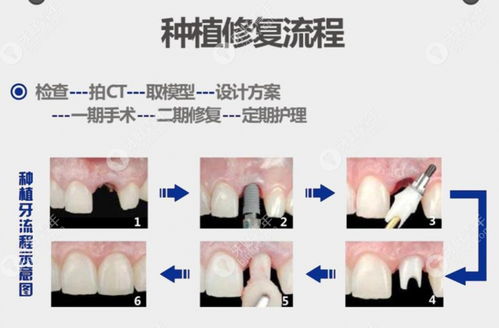 种植牙全部费用一般多少钱