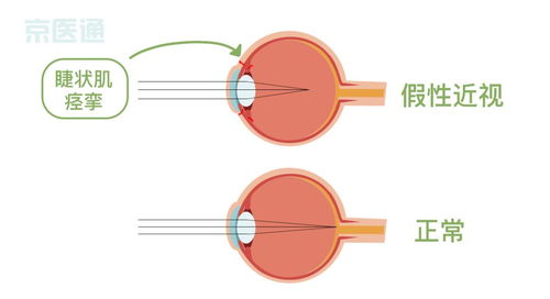 如何让散光眼恢复啊？