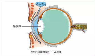 如何让散光眼恢复啊？